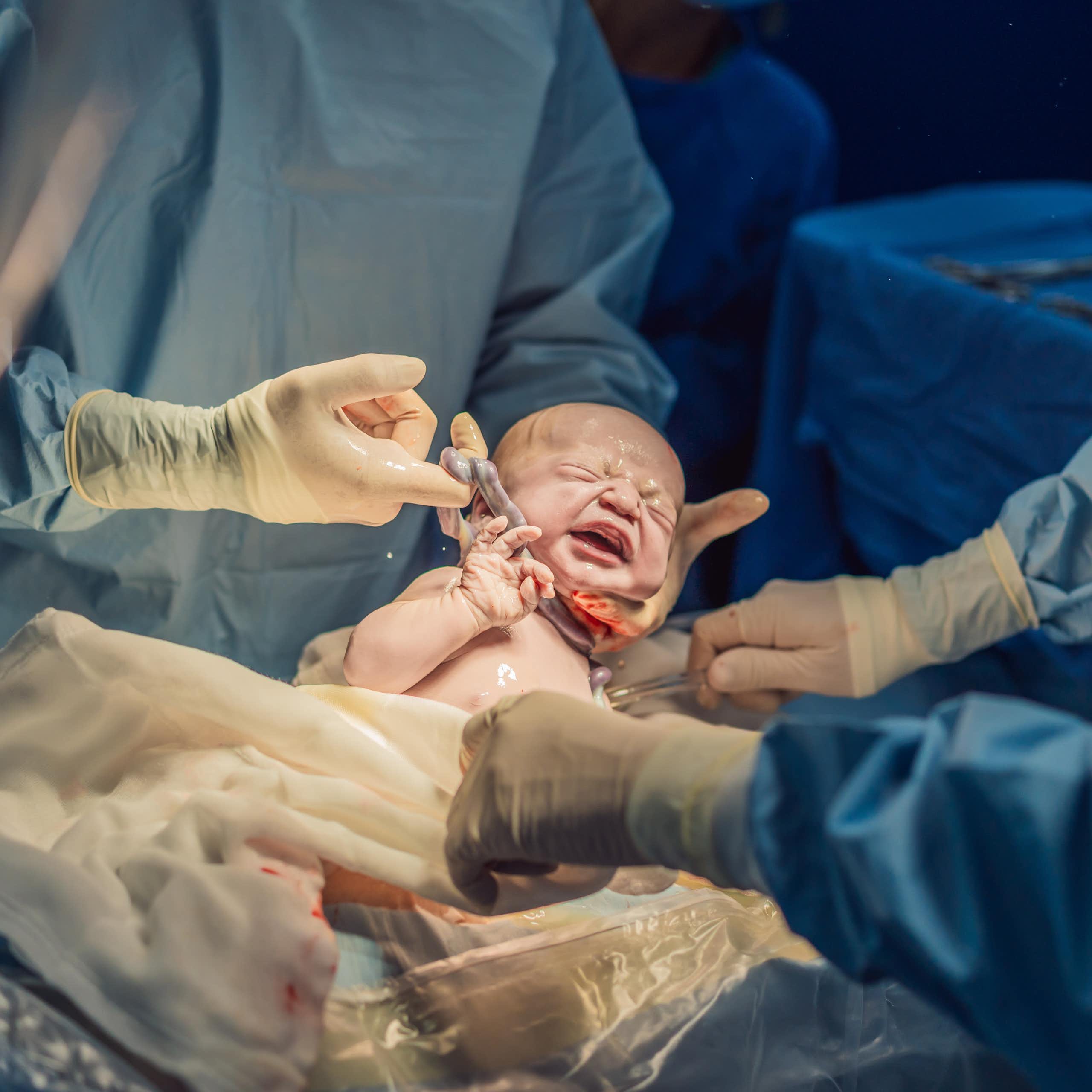 Um recém-nascido cercado por uma equipe médica.