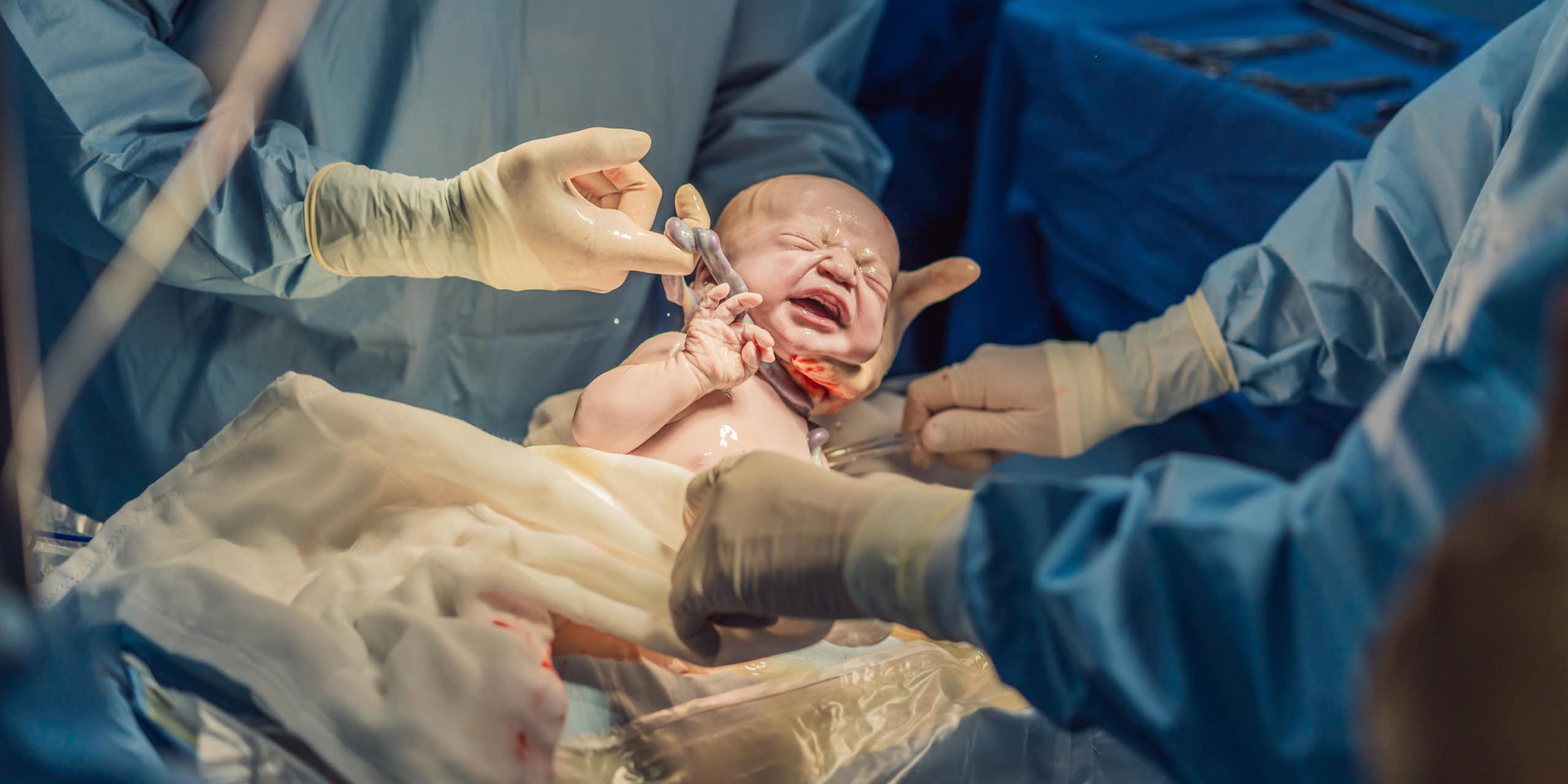 Um recém-nascido cercado por uma equipe médica.